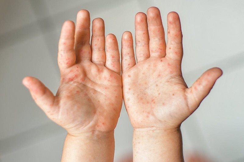Hà Nội ghi nhận 5 ổ dịch tay chân miệng tại các quận, huyện trong một tuần